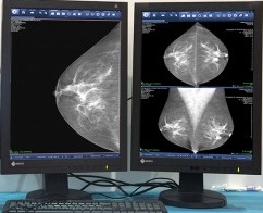 , O papel do PACS no tratamento do câncer de mama