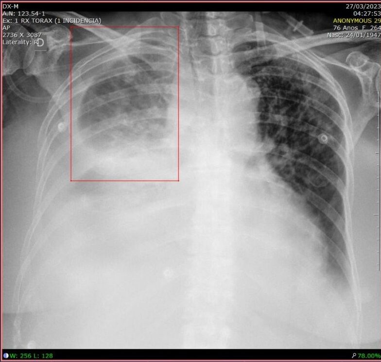 intelig&ecirc;ncia artificial na radiologia, Intelig&ecirc;ncia Artificial na Sa&uacute;de: exemplos de IA para radiologia