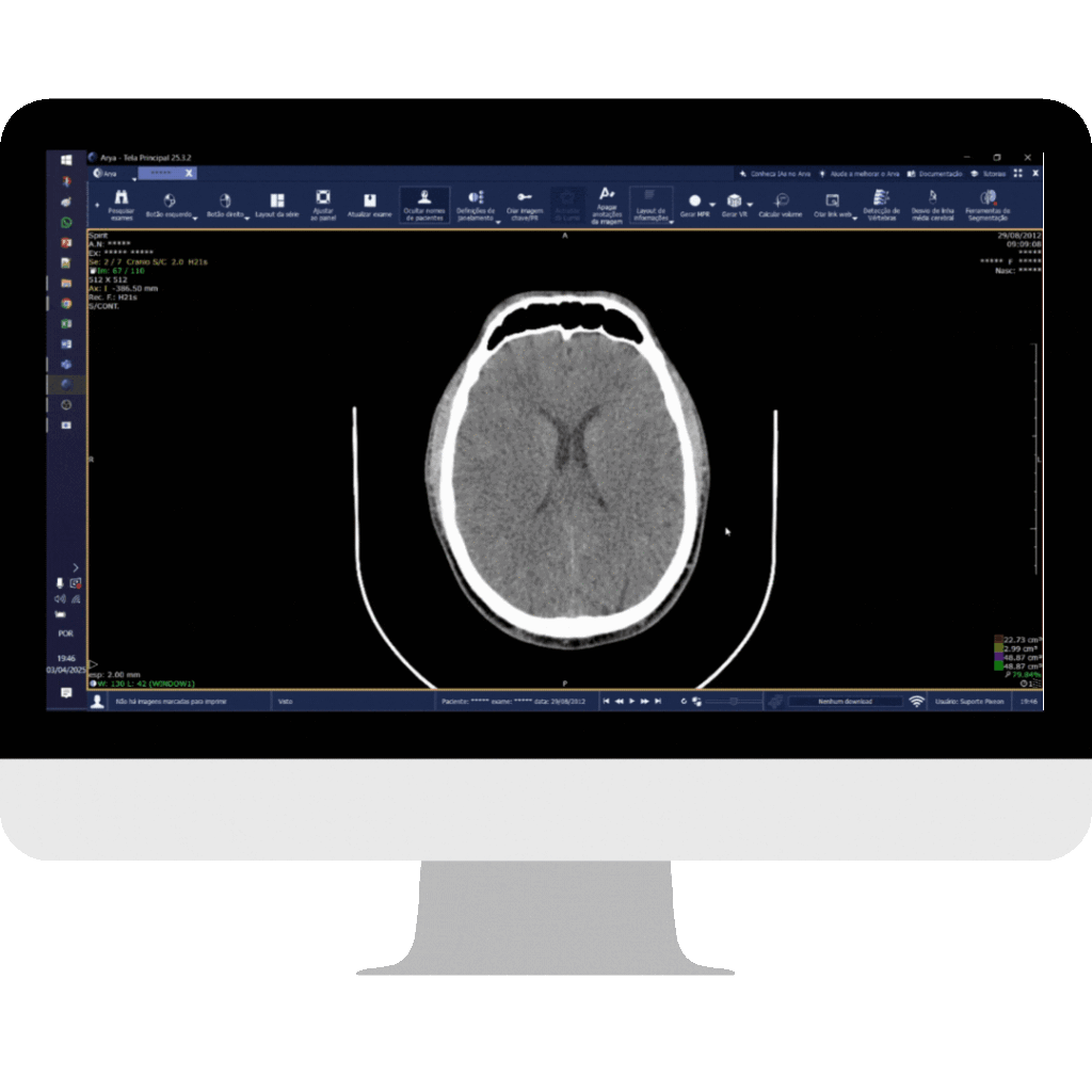 New Midline Brain Tool Included in PACS Pixeon Aurora