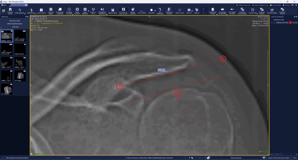 PACS Pixeon New Tool for Measuring Distances in Orthopedic Exams